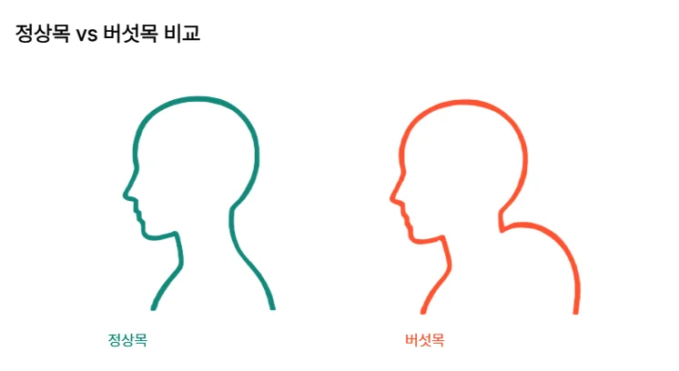 정상 목과 버섯목의 목 뒤 돌출 형태를 비교한 모식도